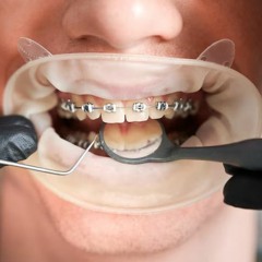 Common Concerns Before Full Mouth Reconstruction at Coastal Smiles