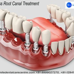 Painless Root Canal Treatment Therapy in Faridabad And Delhi
