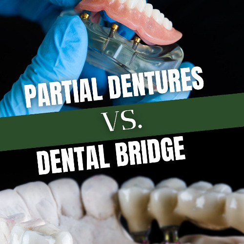Dental Bridge vs. Partial Denture: Which Tooth Replacement Option Is Best?