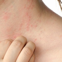 Pityriasis Relief | Reduce Scaly Rashes & Restore Natural and Beautiful Skin