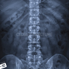 Closed Fracture