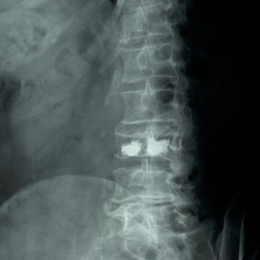 Spine Fracture