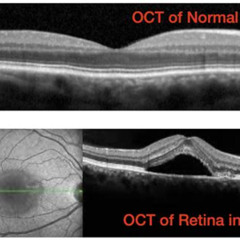 Best Csr Eye Disease Treatment Reviews