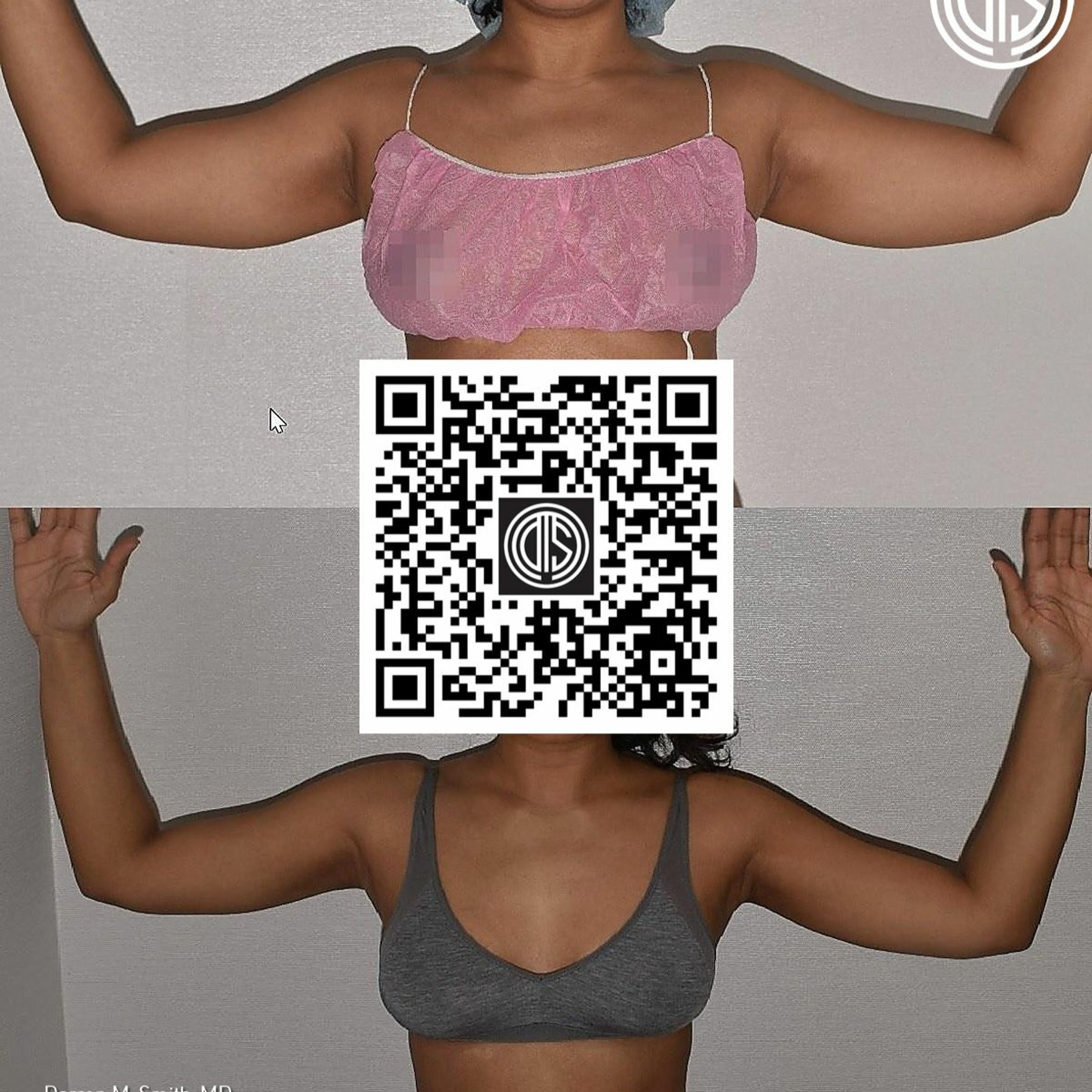 Arm Liposuction near Upper Manhattan - Transform Your Silhouette with Dr. Darren Smith episode artwork