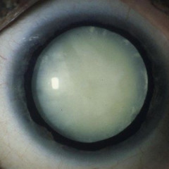 EYELASH