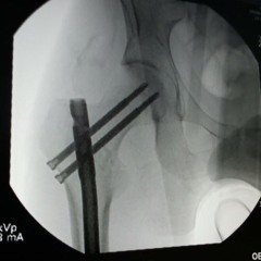 femur