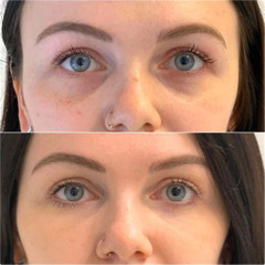 Best Non Surgical Treatment For Under Eye Hollows Reviews