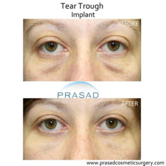 Best Under Eye Treatment For Hollow Eyes Reviews