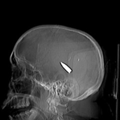 Head Explosion