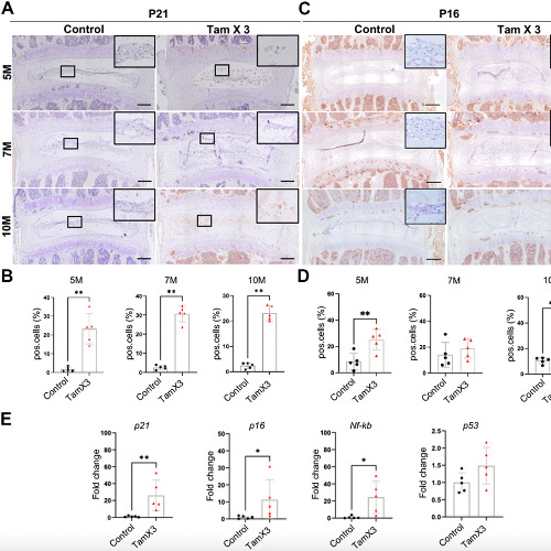 Overactive Runx1 Gene Triggers Early Disc Degeneration Linked to Aging