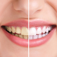 Teeth Whitening Options Safe Ways to Brighten Your Smile