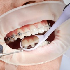 Unlocking Your Perfect Smile: The Purpose of Braces Treatment