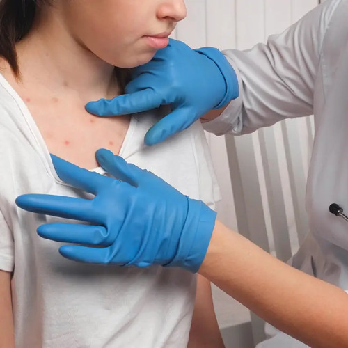 5 things you need to know about measles