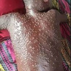 Français - L'épidémie du Mpox sévit de plus en plus en RDC