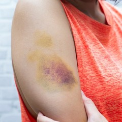 Quick Bruise Recovery | Reduce the Reddish Spot & Speed Up Blood Vessel Recovery