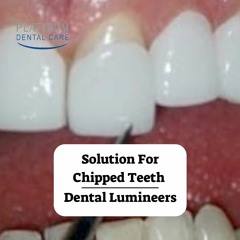 Solution For Chipped Teeth | Dental Lumineers