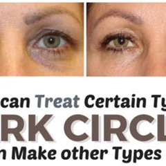 Best Dark Eye Circles Treatment Reviews