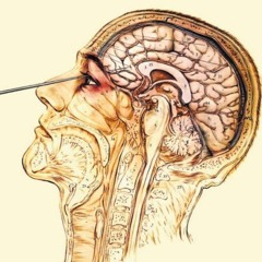 lobotomie