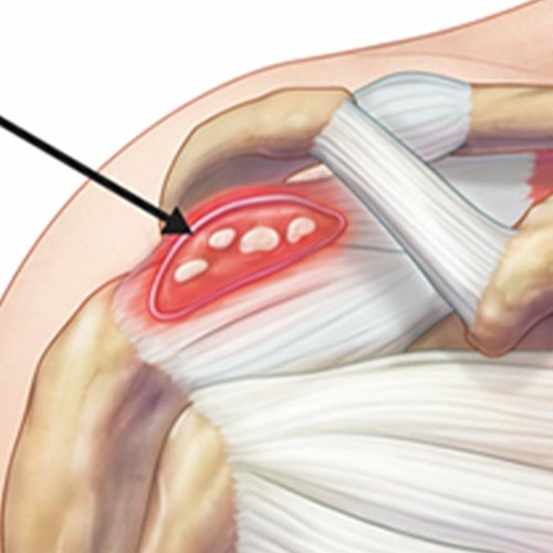 Calcification Treatment | Balance Calcium in the Body & Stop the Hardening of Soft Tissues