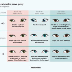 Best Nerve Palsy Eye Treatment Reviews