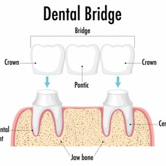 The Purpose of Dental Bridges and Crowns