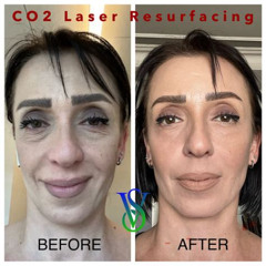Best Under Eye Bags Treatment Laser Reviews