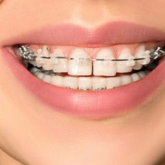 Explore - How Can a Dental Implant Improve Your Smile?