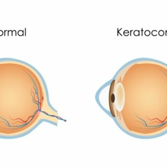 Keratoconus: A Guide To Symptoms, Causes, And Care