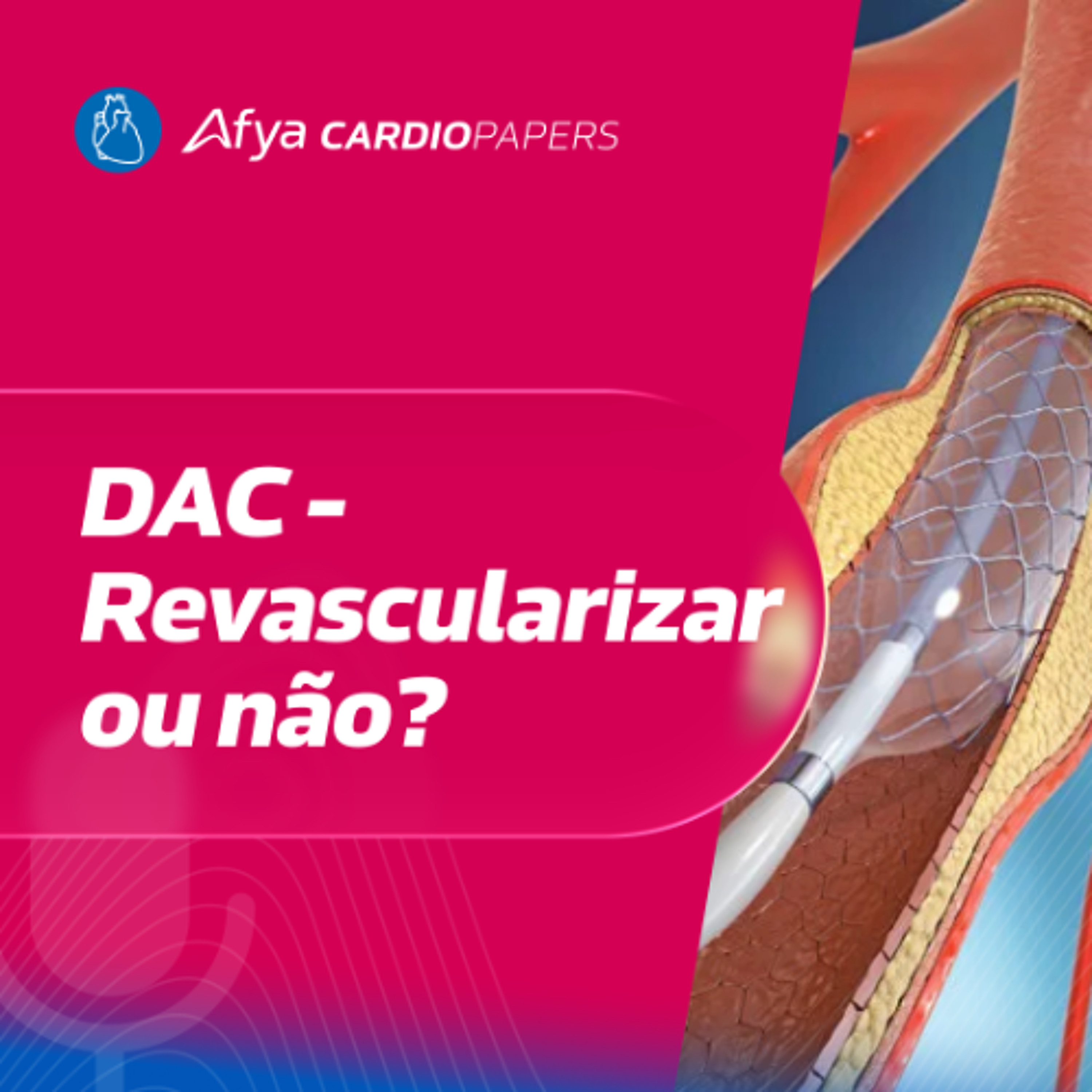 Revascularização na DAC: quando e para quem?