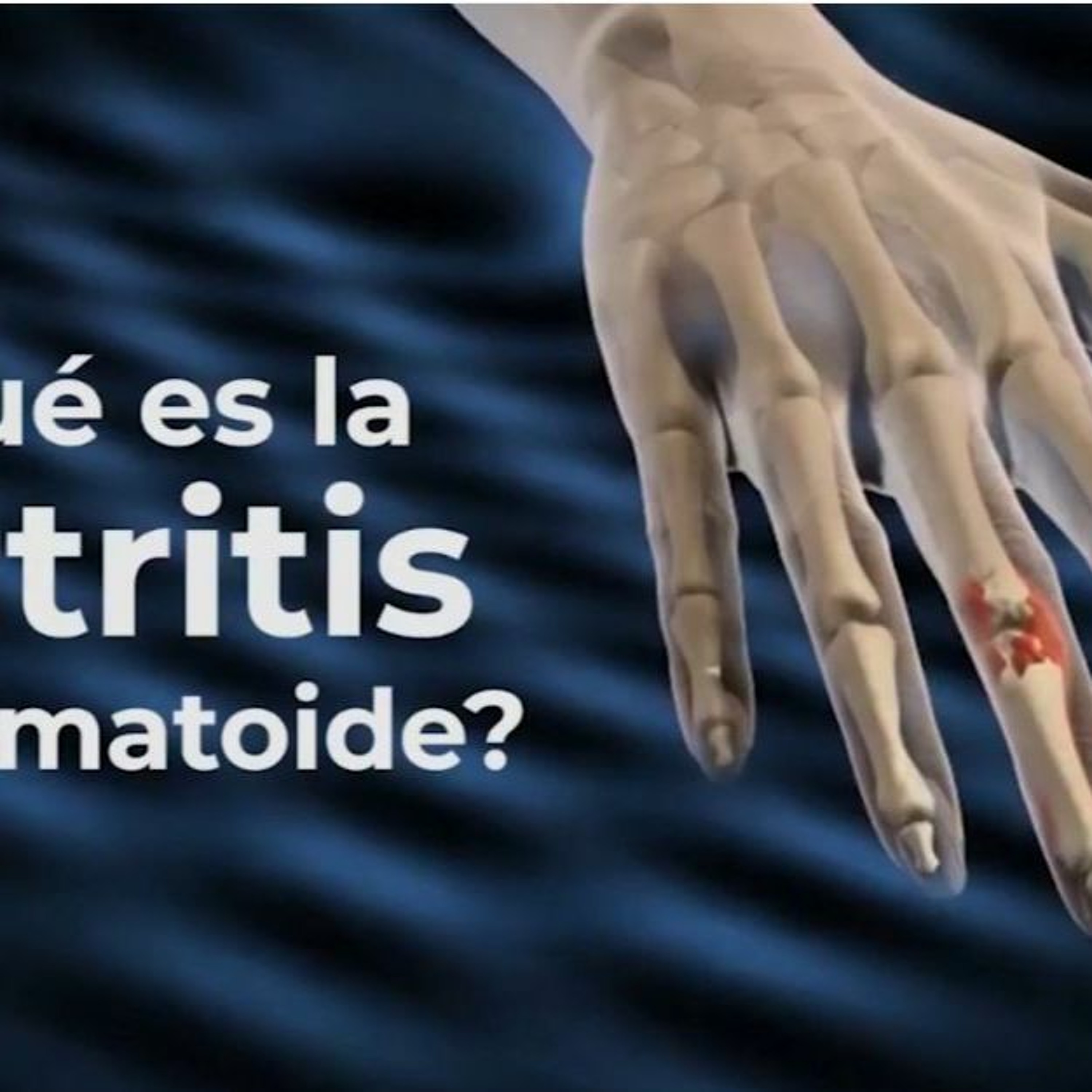 Artritis Reumatoide
