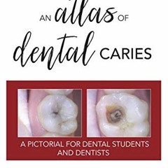 [READ] PDF 🗃️ An Atlas of Dental Caries: A Pictorial For Dental Students and Dentist