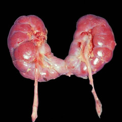 Horseshoe kidney  (prod.by Geekinz)