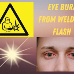 Best Welding Flash Burn Eyes Home Treatment Reviews