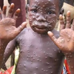 Français - L'épidémie du Monkeypox sévit dans 23 des 26 provinces de la RDC