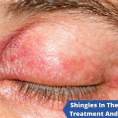 Best Treatment Shingles In Eye Reviews