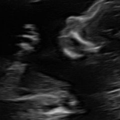 stella's heartbeat