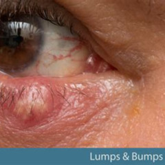 Best Eye Bumps On Eyelid Treatment Reviews