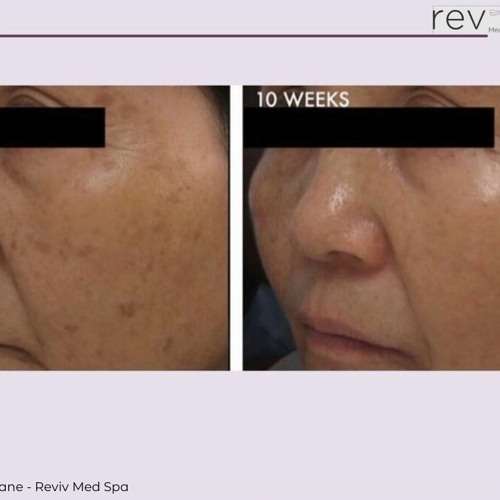 Restylane - Reviv Med Spa