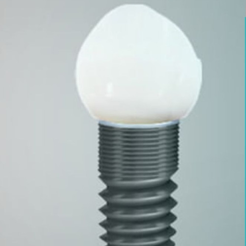 The Step-by-Step Guide to Getting Dental Implants in Raleigh