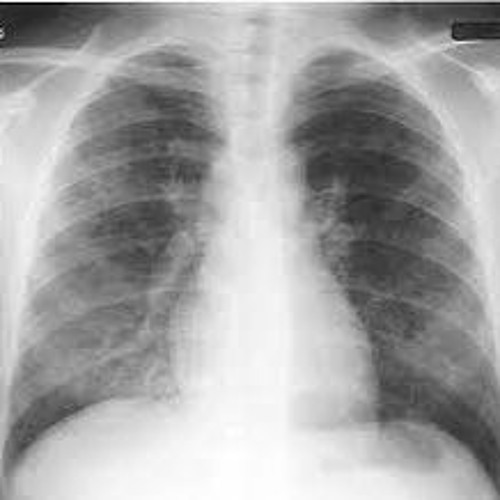 Stream Learn How to Look at a Chest XRay with Chest XRay Made Easy