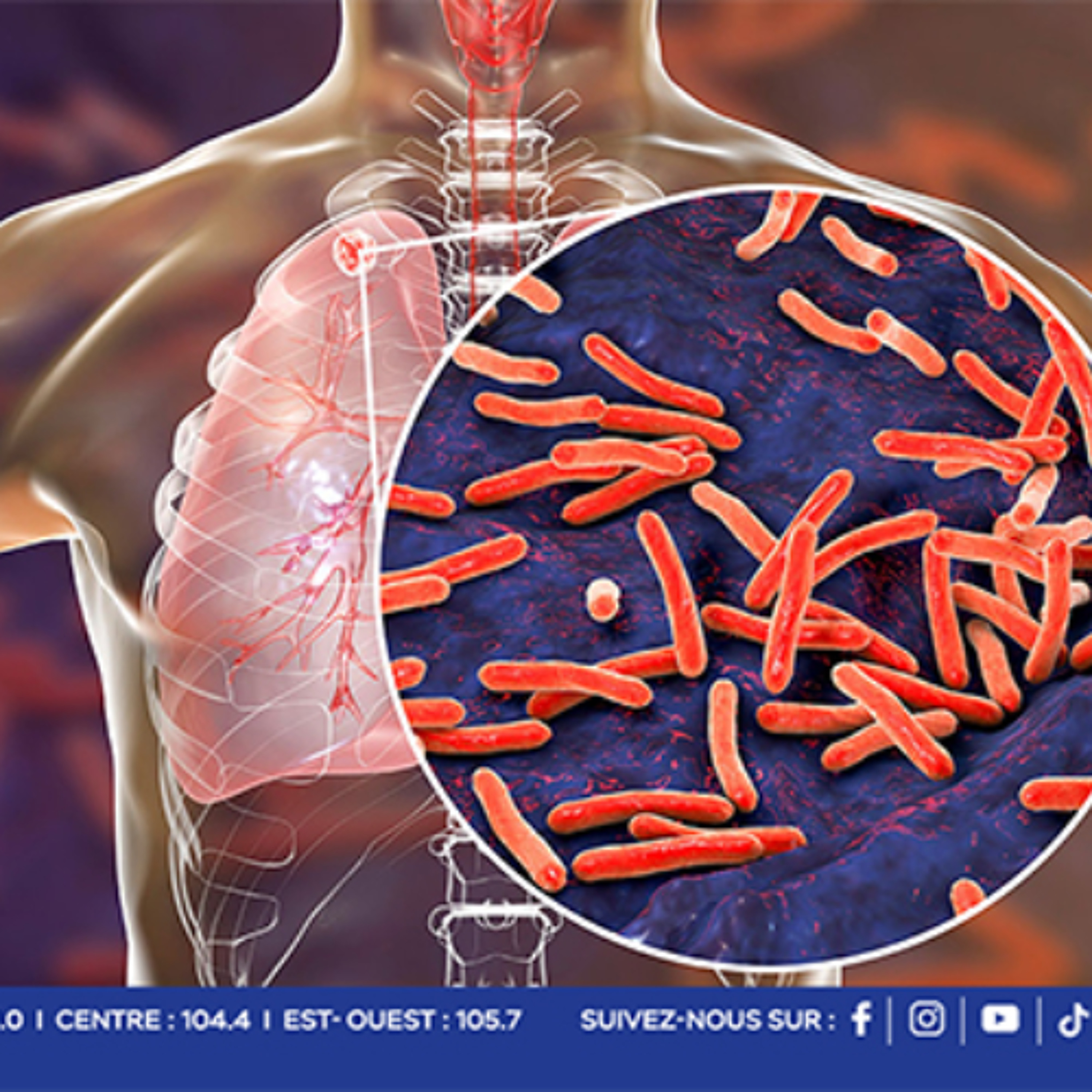 Journée mondiale de lutte contre la tuberculose : « Une maladie avec plus de 120 cas par an  », selon le Dr Rajiv Kumar episode artwork