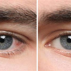 Best Free Laser Eye Treatment Reviews
