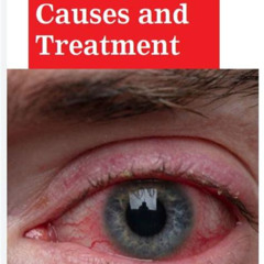Best Red Eye Causes Treatment Reviews