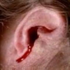 Oorkanker