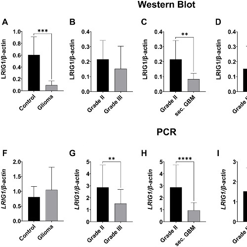 Lower LRIG1 Expression Linked to Aggressive Gliomas