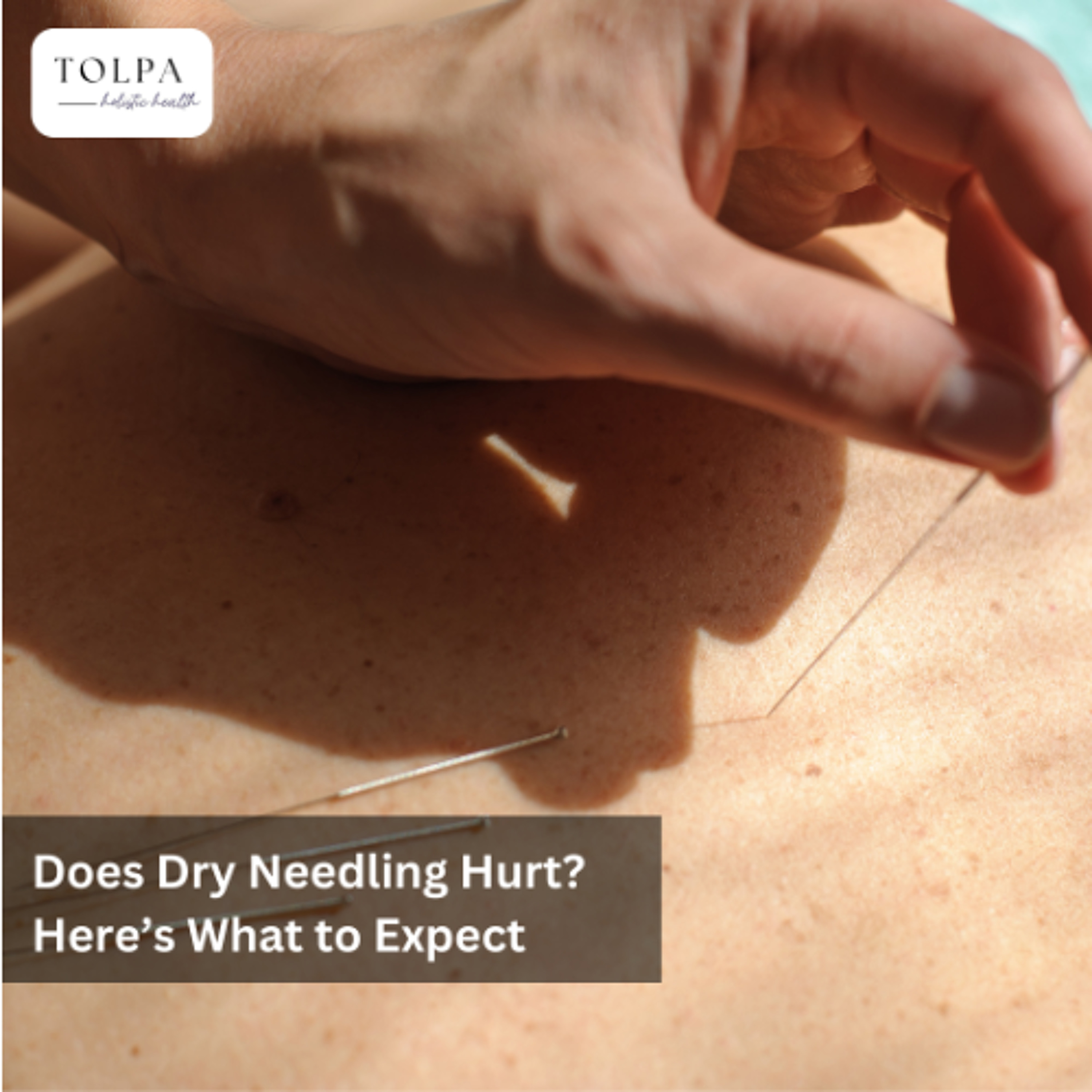 Does Dry Needling Hurt Here’s What to Expect