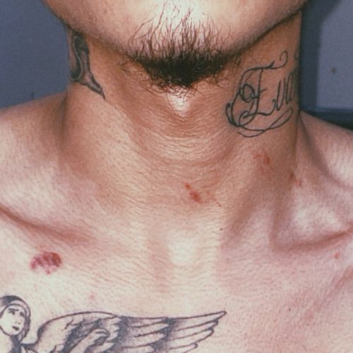 love bites