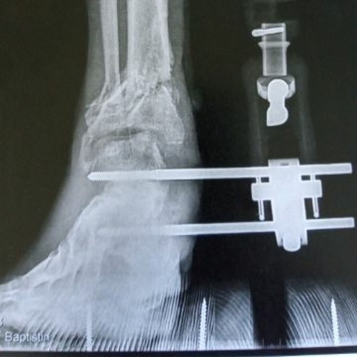 "OviSom"  >> convalescence 4