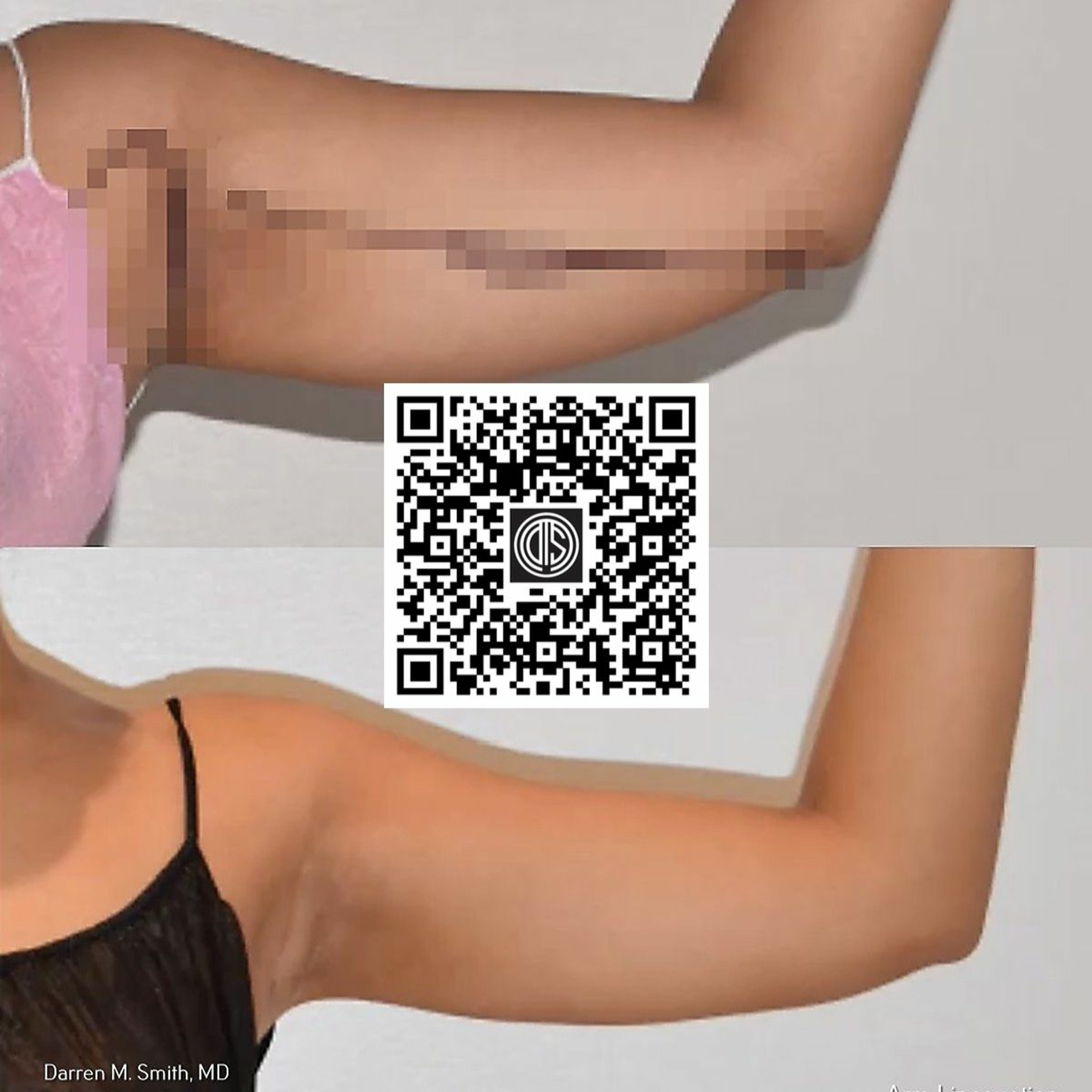 Arm Liposuction Expert Near Midtown East Manhattan NYC episode artwork