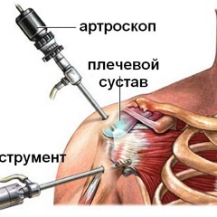 Коли необхідна артроскопія плеча?
